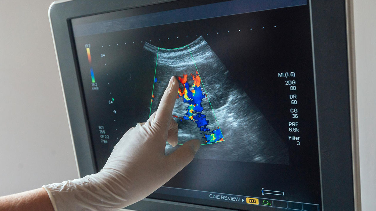 Color Doppler