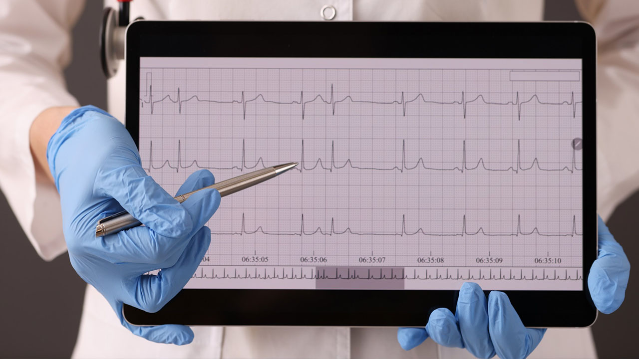 ECG